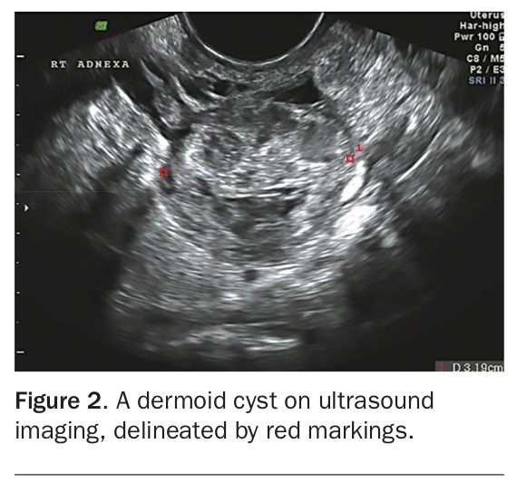 Dermoid Ovarian Cyst Ultrasound 0835